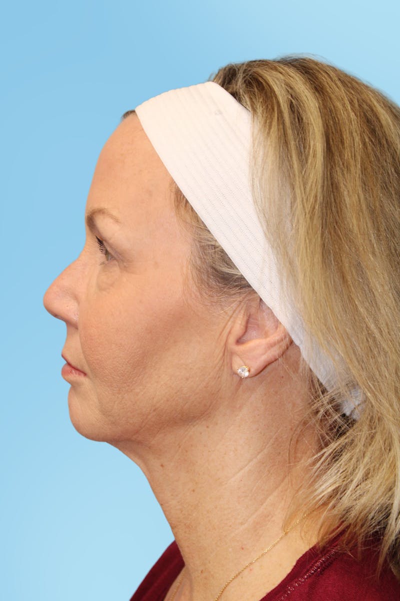 FaceTite Before & After Gallery - Patient 321663 - Image 4