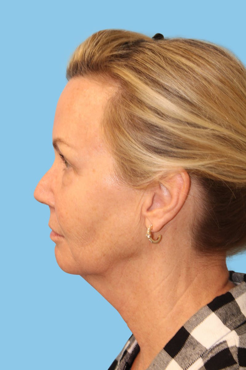 FaceTite Before & After Gallery - Patient 321663 - Image 3
