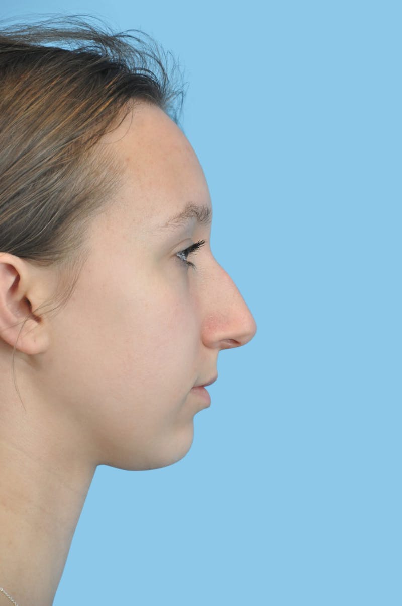 Chin Augmentation Before & After Gallery - Patient 275600 - Image 1
