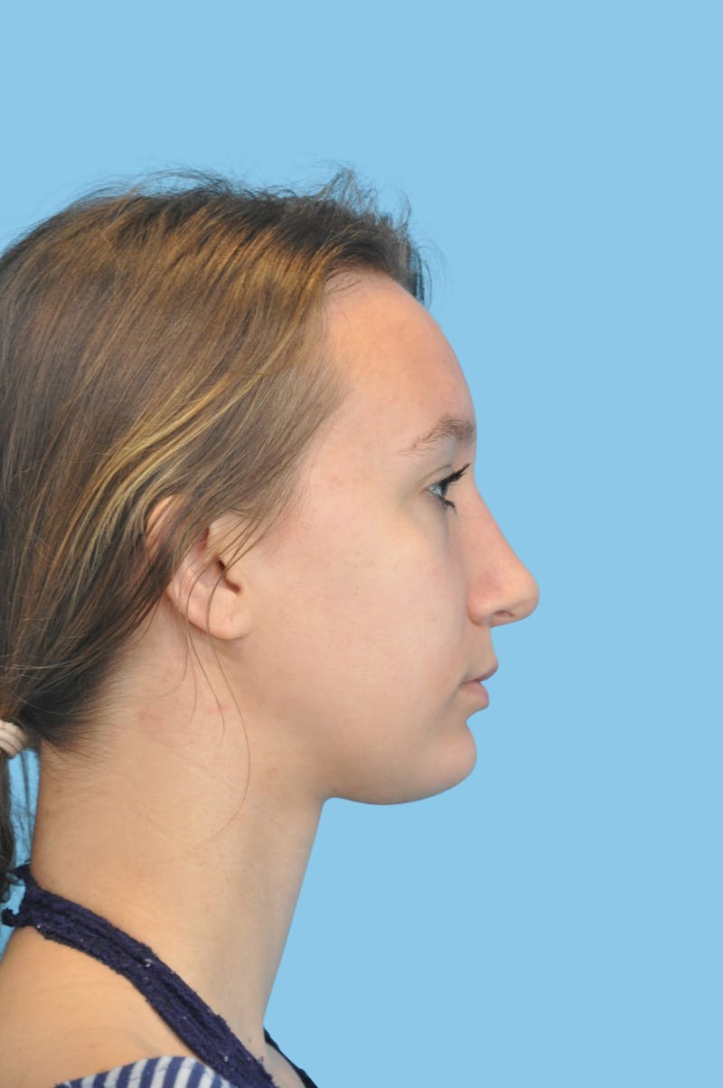 Chin Augmentation Before & After Gallery - Patient 275600 - Image 2