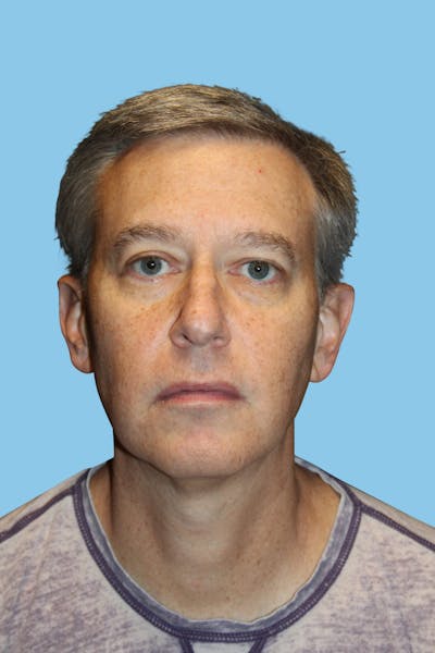 Ear Surgery Before & After Gallery - Patient 174920 - Image 1