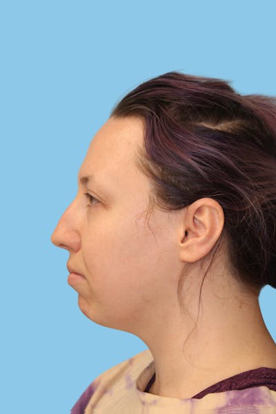 Chin Augmentation Before & After Gallery - Patient 325139 - Image 1