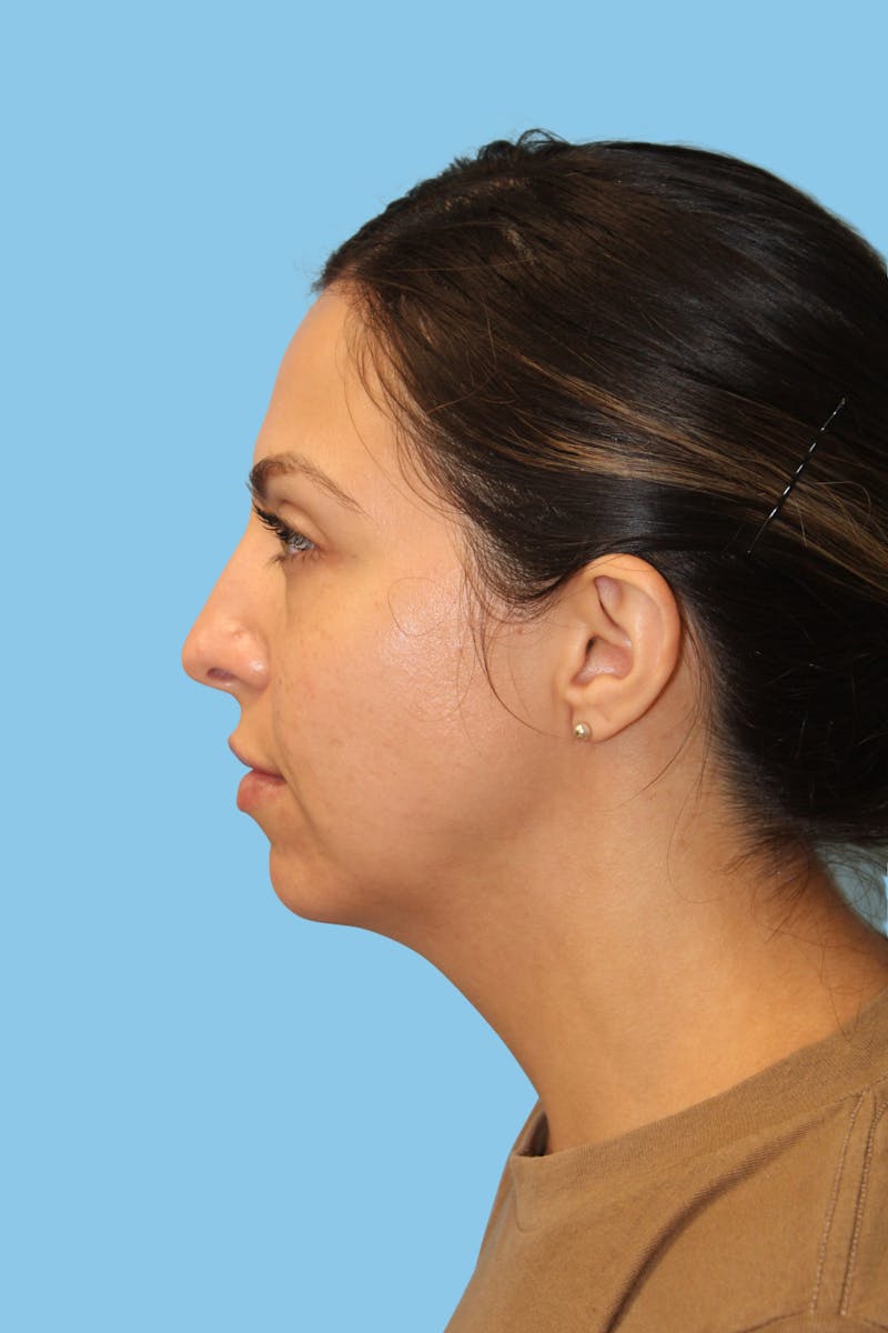 Chin Augmentation Before & After Gallery - Patient 171912 - Image 1