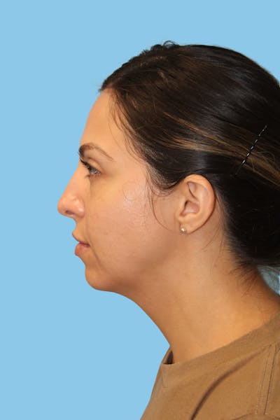 Chin Augmentation Before & After Gallery - Patient 171912 - Image 1