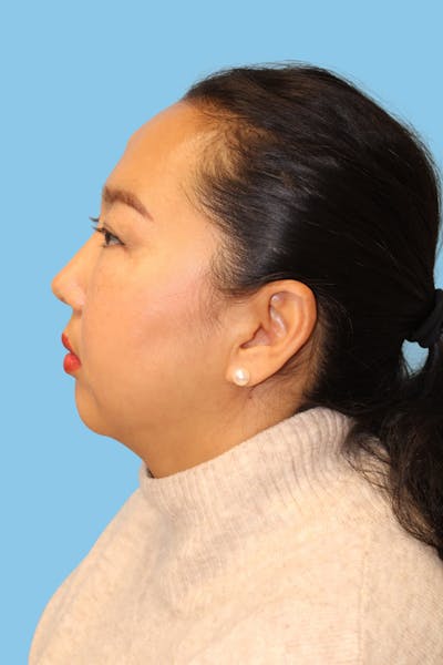 Chin Augmentation Before & After Gallery - Patient 112106 - Image 1
