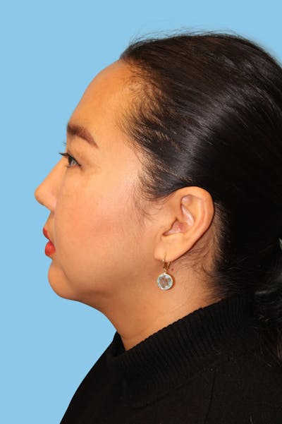 Chin Augmentation Before & After Gallery - Patient 112106 - Image 2