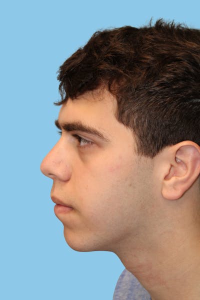 Chin Augmentation Before & After Gallery - Patient 207718 - Image 1
