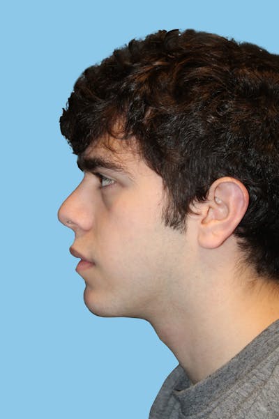 Chin Augmentation Before & After Gallery - Patient 207718 - Image 2