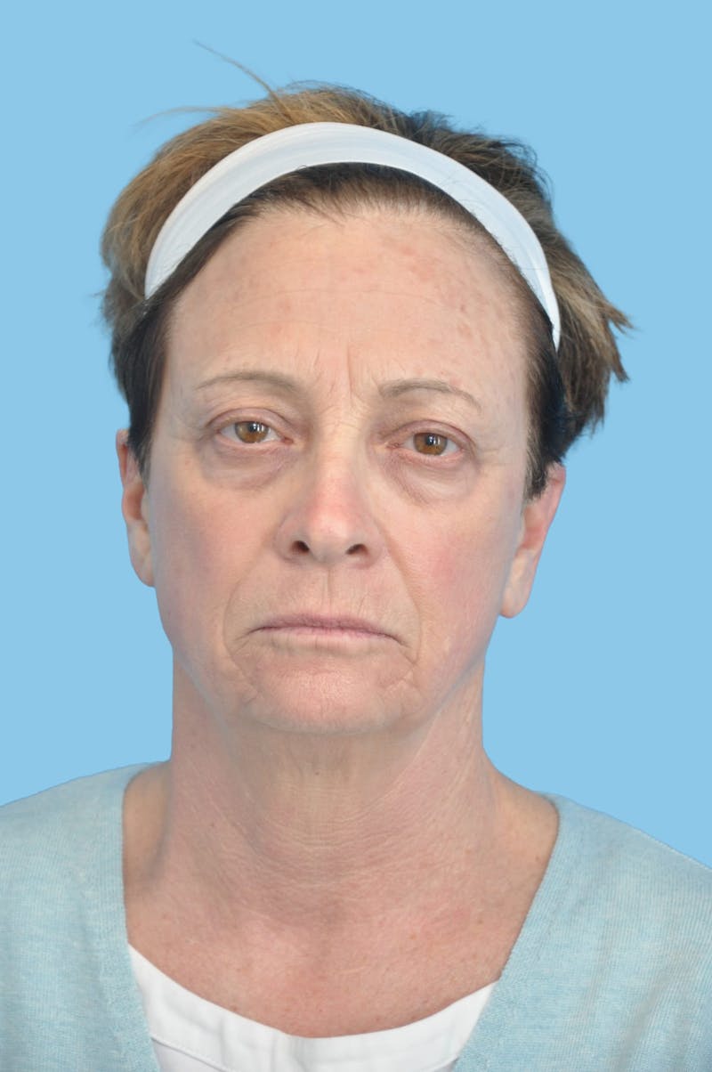 Facelift & Necklift Before & After Gallery - Patient 275399 - Image 2