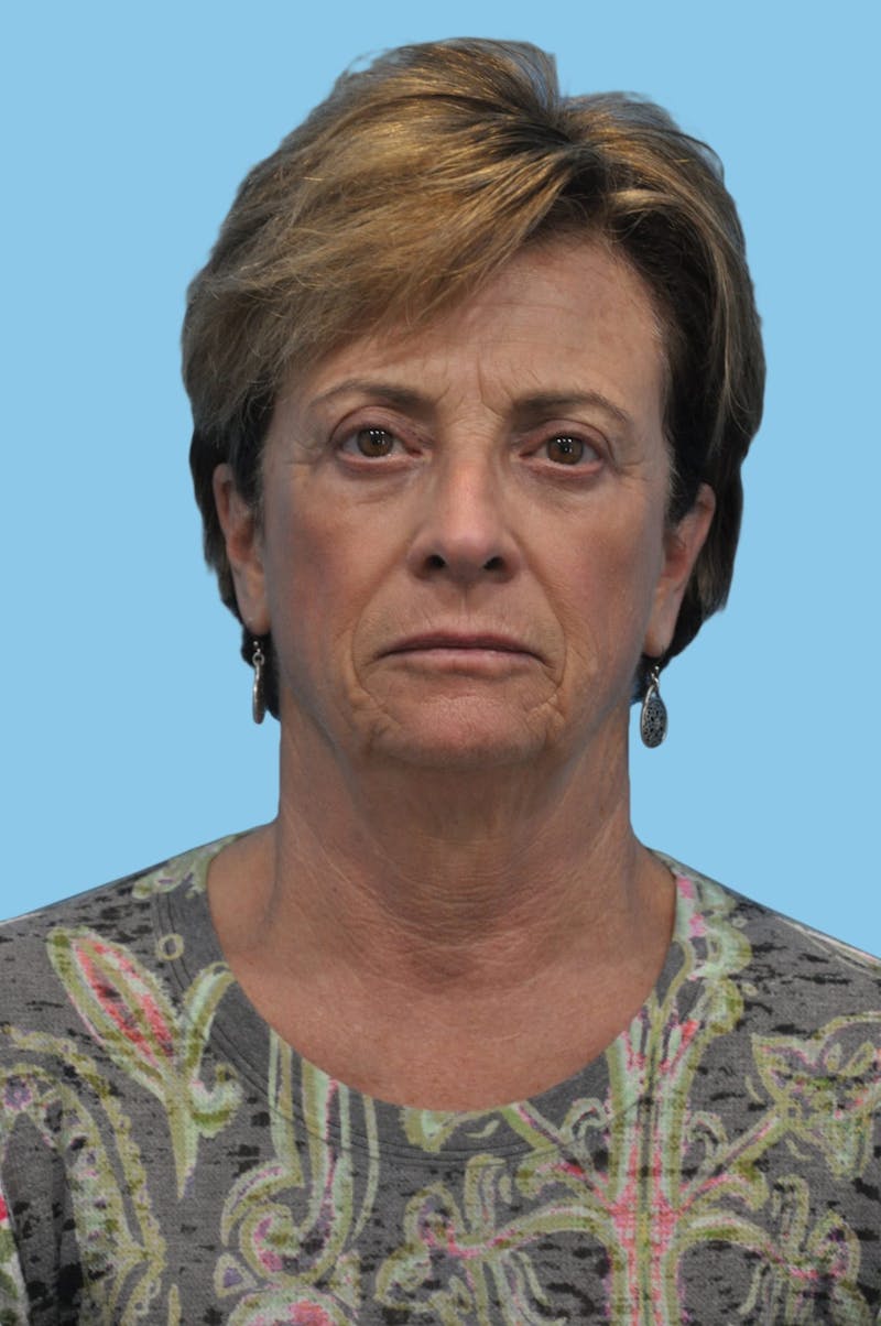 Facelift & Necklift Before & After Gallery - Patient 275399 - Image 1