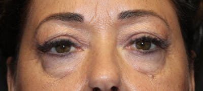 Eye Surgery Before & After Gallery - Patient 403593 - Image 1