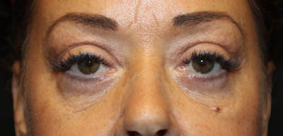 Eye Surgery Before & After Gallery - Patient 403593 - Image 2