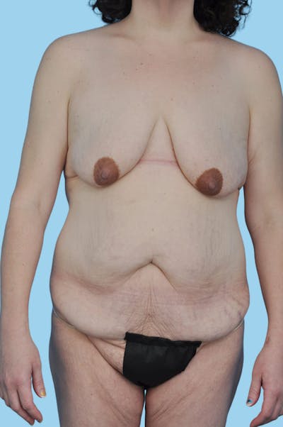 Body Contouring Before & After Gallery - Patient 296564 - Image 1
