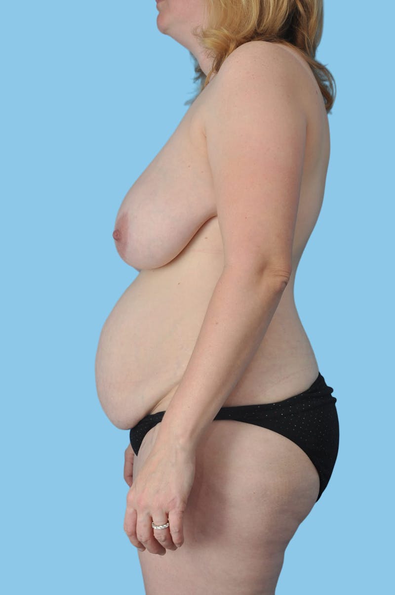 Breast Reduction Before & After Gallery - Patient 281218 - Image 3