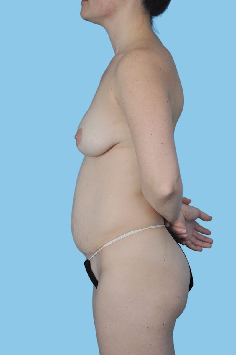 Breast Augmentation Before & After Gallery - Patient 273099 - Image 4