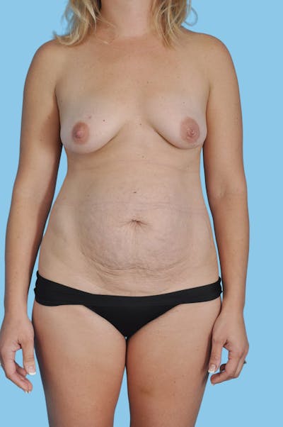 Body Contouring Before & After Gallery - Patient 214016 - Image 1