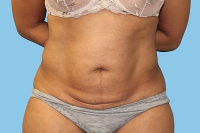 Tummy Tuck Before & After Gallery - Patient 271952 - Image 1