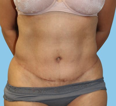 Tummy Tuck Before & After Gallery - Patient 271952 - Image 2