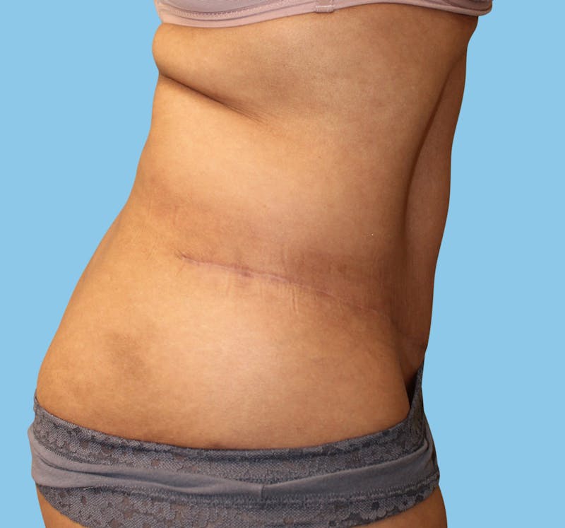 Body Contouring Before & After Gallery - Patient 333175 - Image 4
