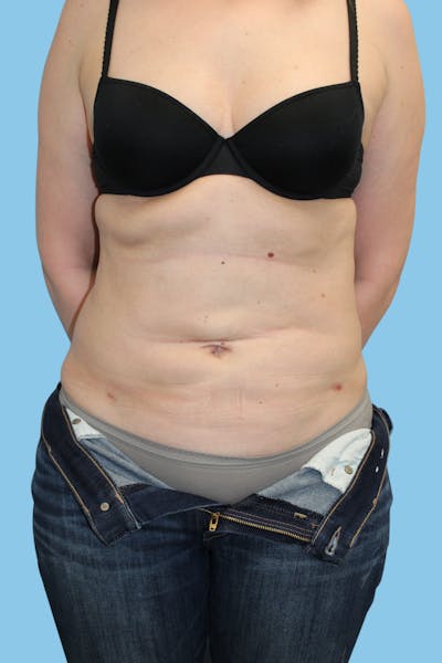 BodyTite Before & After Gallery - Patient 917638 - Image 2