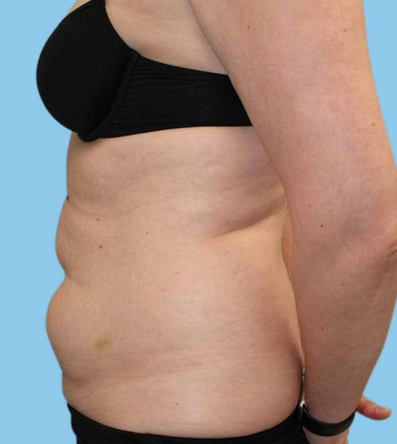 BodyTite Before & After Gallery - Patient 917638 - Image 3