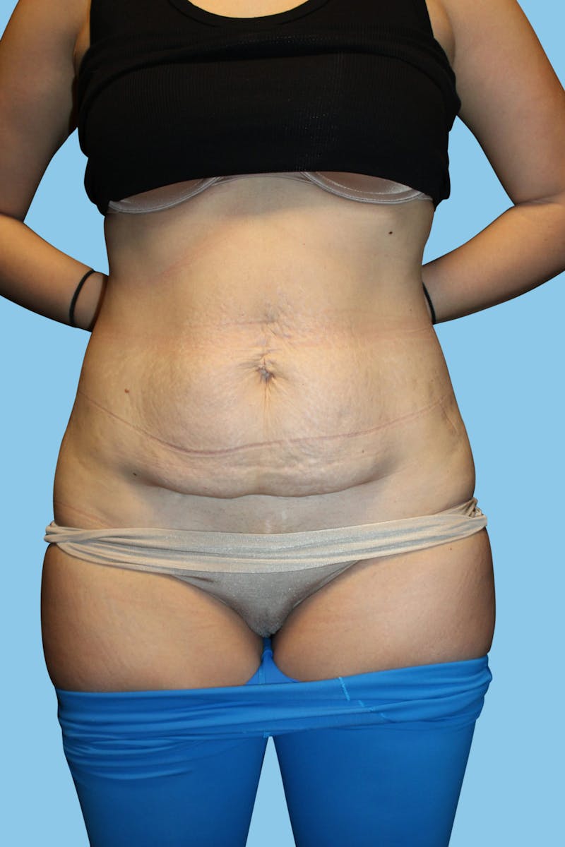 Tummy Tuck Before & After Gallery - Patient 158489 - Image 1