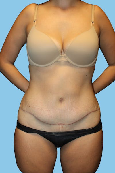 Tummy Tuck Before & After Gallery - Patient 158489 - Image 2