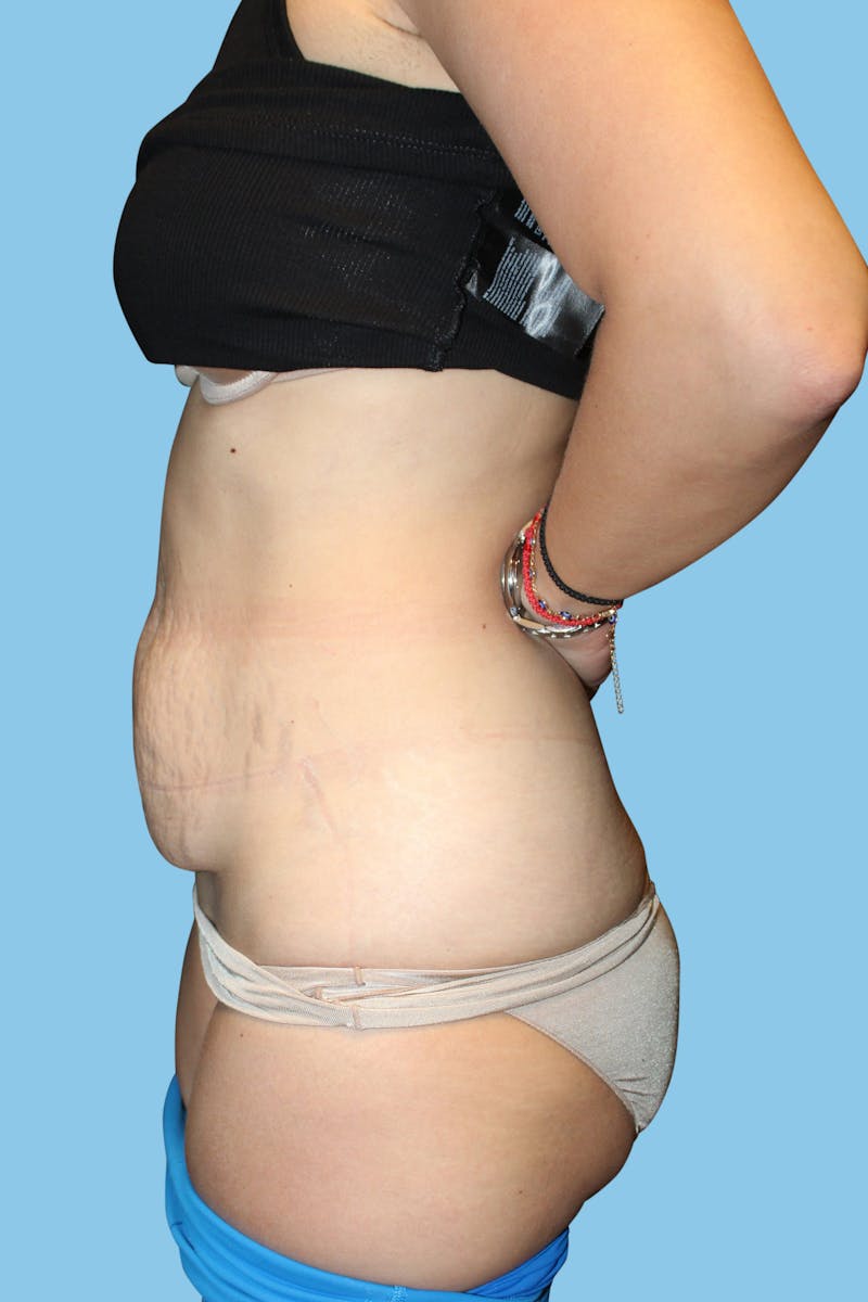 Tummy Tuck Before & After Gallery - Patient 158489 - Image 3