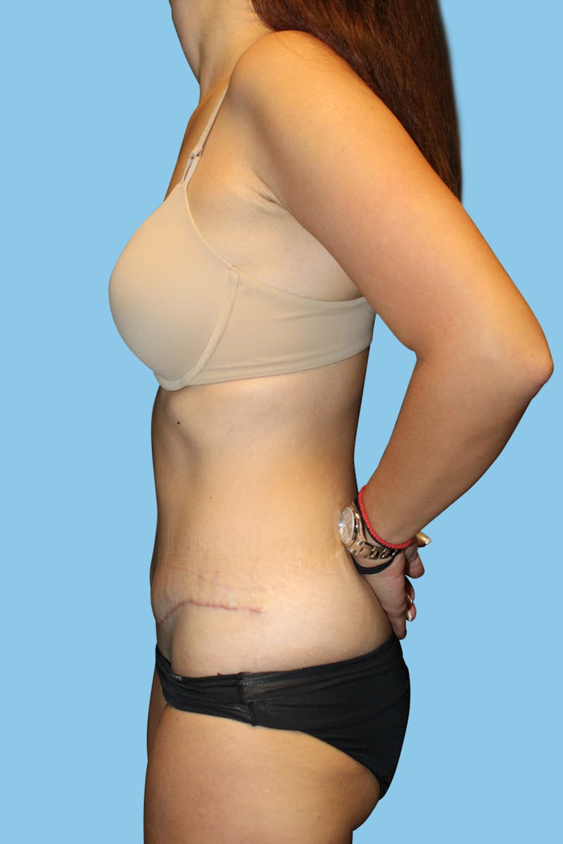 Tummy Tuck Before & After Gallery - Patient 158489 - Image 4