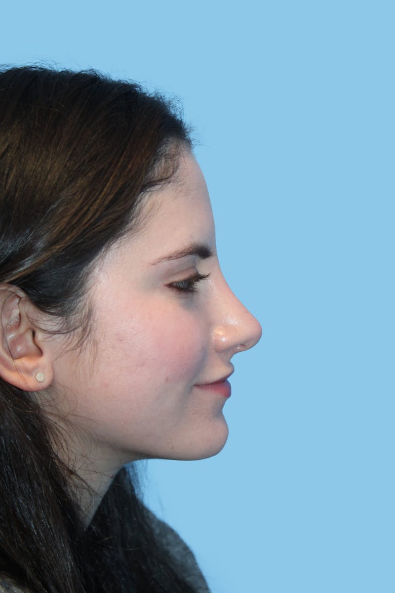 Rhinoplasty Before & After Gallery - Patient 230392 - Image 4