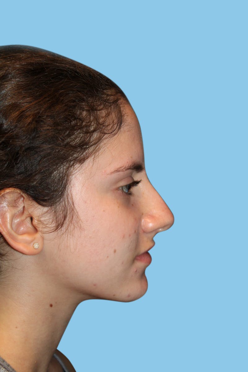 Rhinoplasty Before & After Gallery - Patient 230392 - Image 3