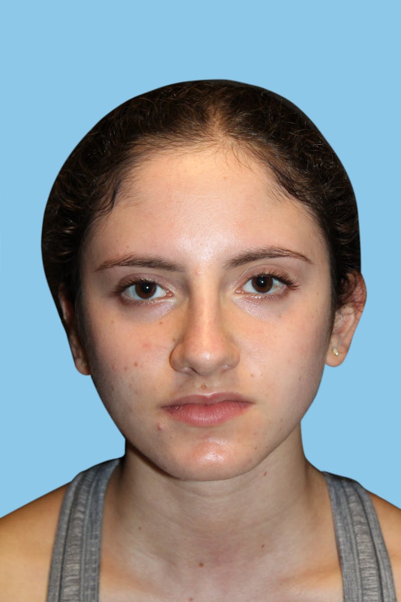 Rhinoplasty Before & After Gallery - Patient 230392 - Image 1
