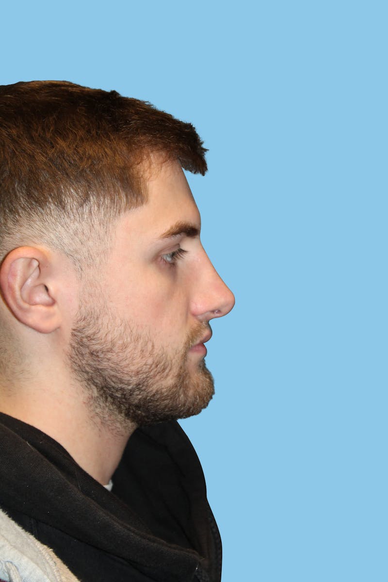 Rhinoplasty Before & After Gallery - Patient 638527 - Image 4
