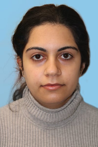 Rhinoplasty Before & After Gallery - Patient 119132 - Image 1