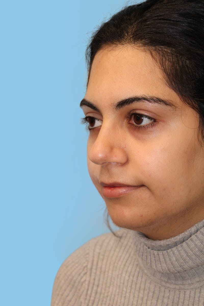 Rhinoplasty Before & After Gallery - Patient 119132 - Image 3