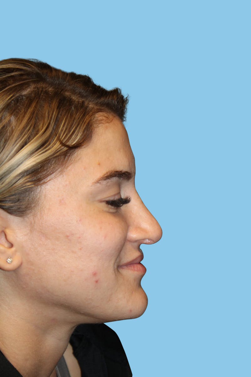 Rhinoplasty Before & After Gallery - Patient 273233 - Image 4