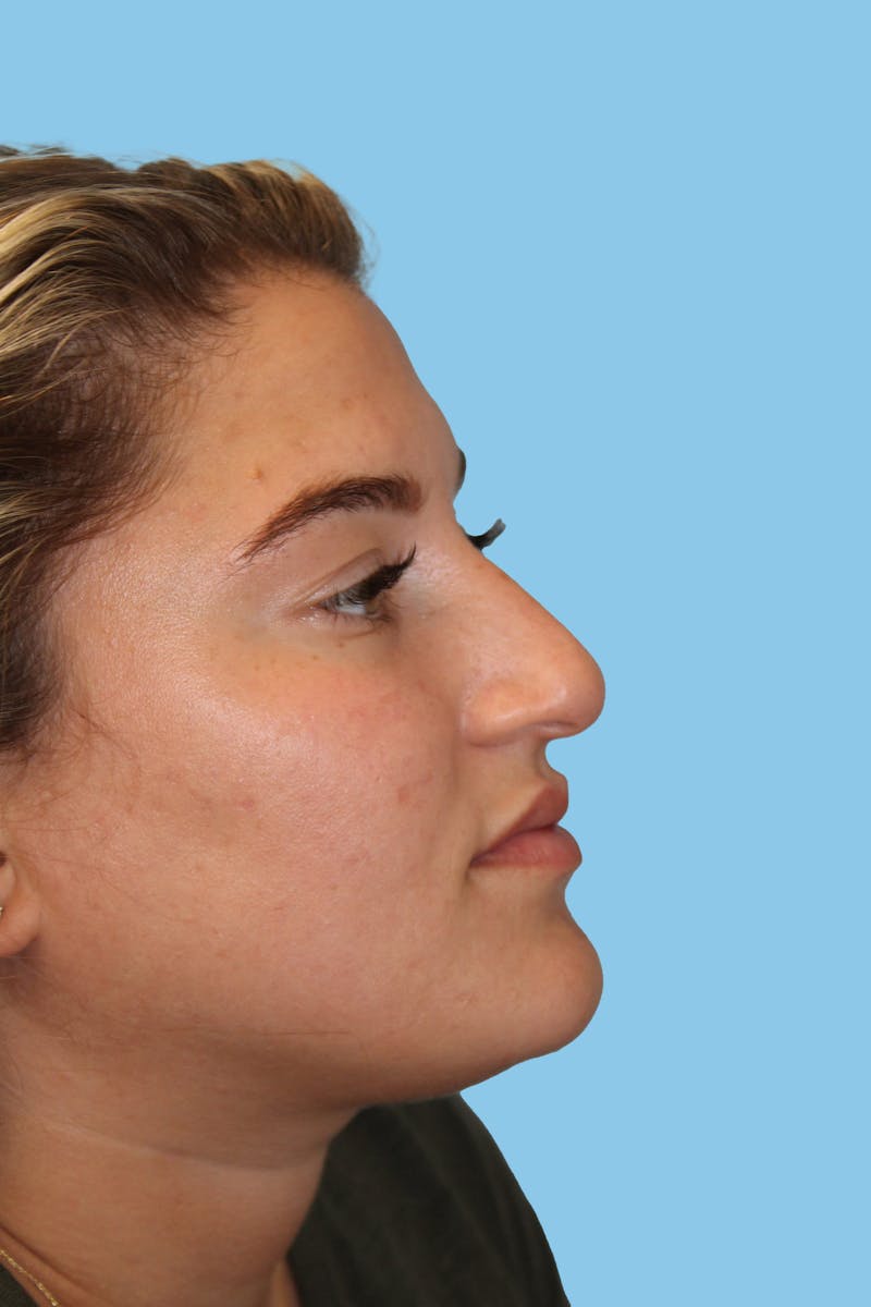 Rhinoplasty Before & After Gallery - Patient 273233 - Image 3