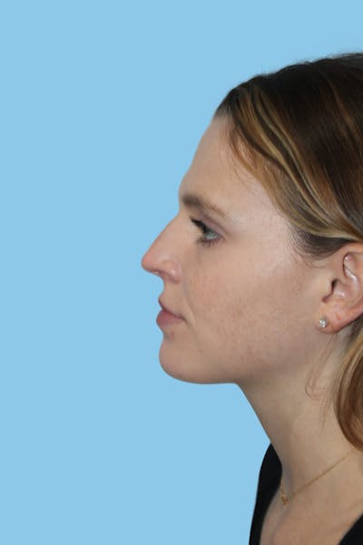 Rhinoplasty Before & After Gallery - Patient 165215 - Image 1