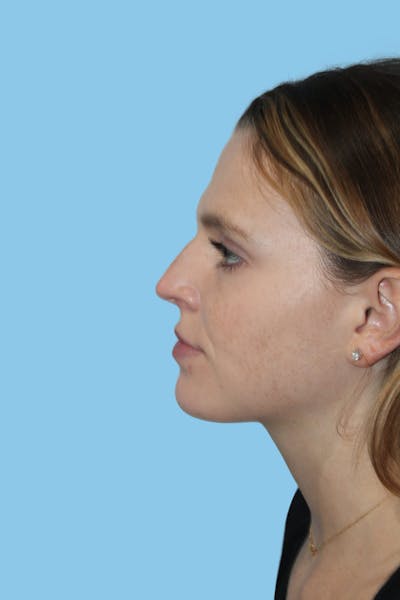 Rhinoplasty Before & After Gallery - Patient 165215 - Image 1