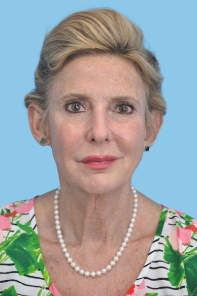 Facelift & Necklift Before & After Gallery - Patient 103420 - Image 1