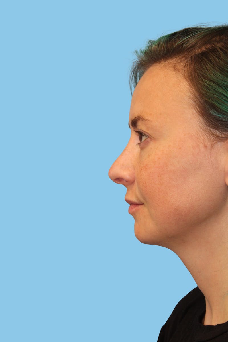 FaceTite Before & After Gallery - Patient 513678 - Image 3