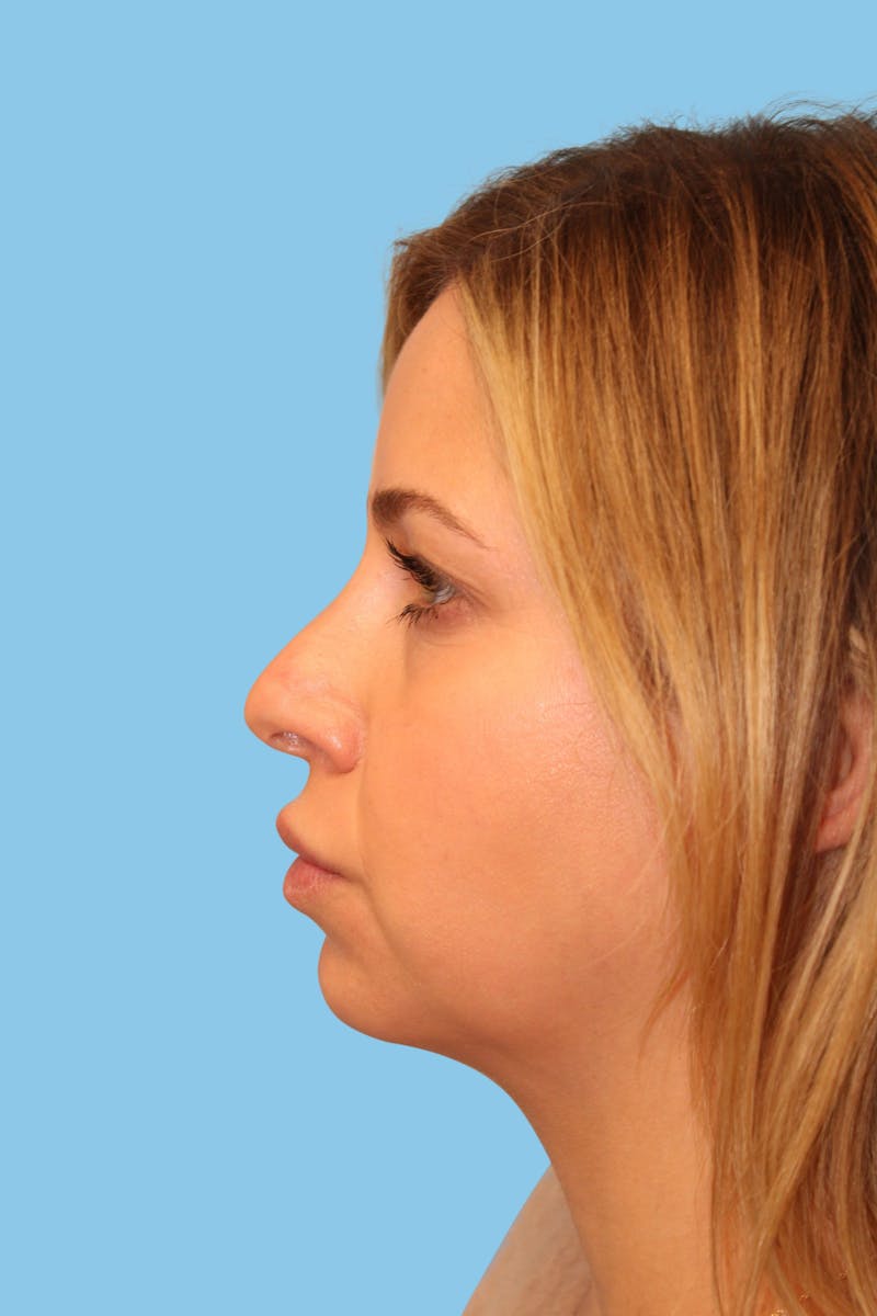 Swift Sculpt Before & After Gallery - Patient 288214 - Image 3