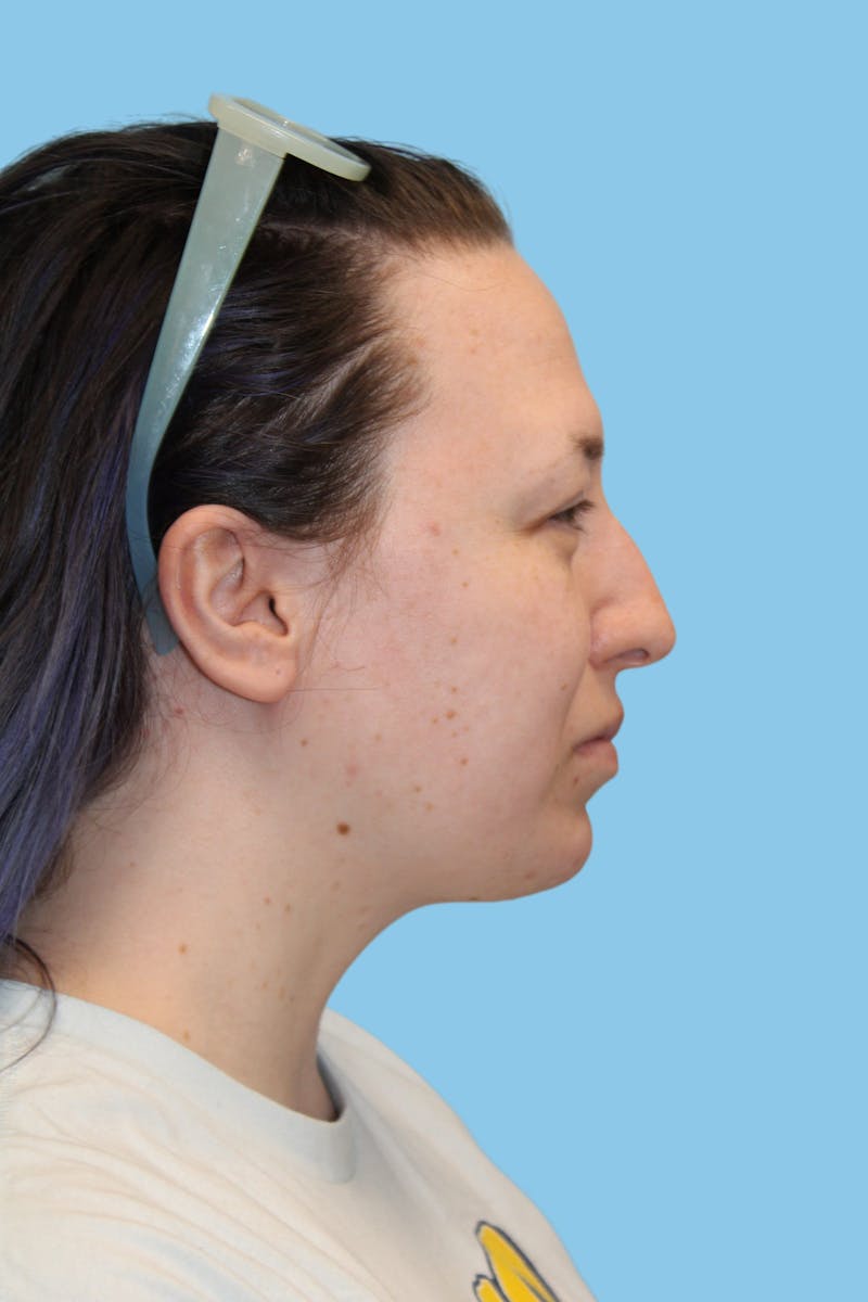 Swift Sculpt Before & After Gallery - Patient 147259 - Image 4