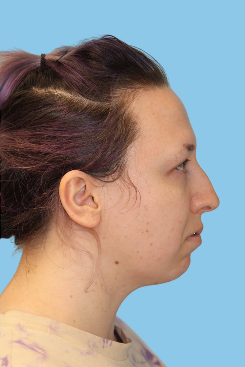 Swift Sculpt Before & After Gallery - Patient 147259 - Image 3