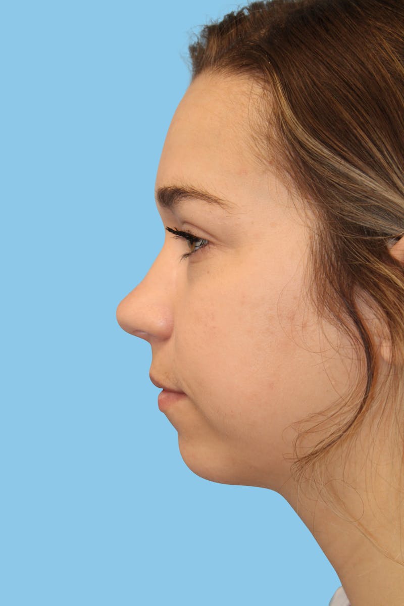 Swift Sculpt Before & After Gallery - Patient 153601 - Image 3