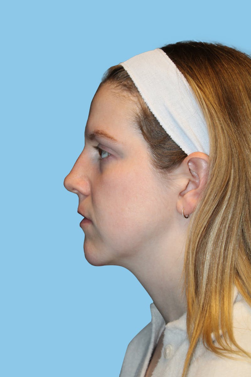 Swift Sculpt Before & After Gallery - Patient 419103 - Image 3