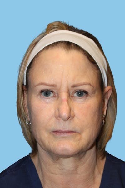 Browlift Before & After Gallery - Patient 144429 - Image 1