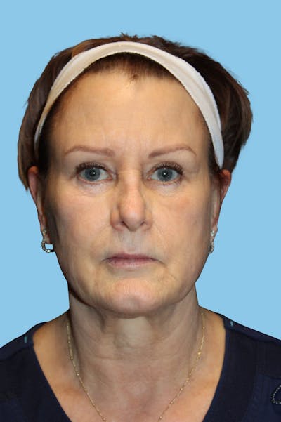 Browlift Before & After Gallery - Patient 144429 - Image 2