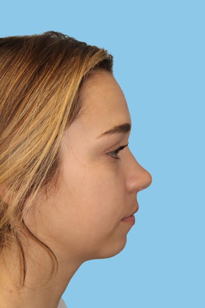 Chin Augmentation Before & After Gallery - Patient 188612 - Image 1