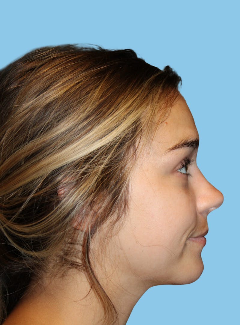 Chin Augmentation Before & After Gallery - Patient 188612 - Image 2
